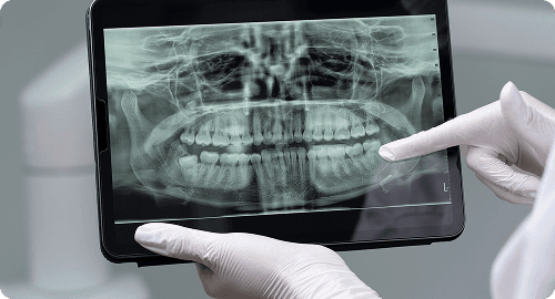 Digital X-Rays (Radiographs)